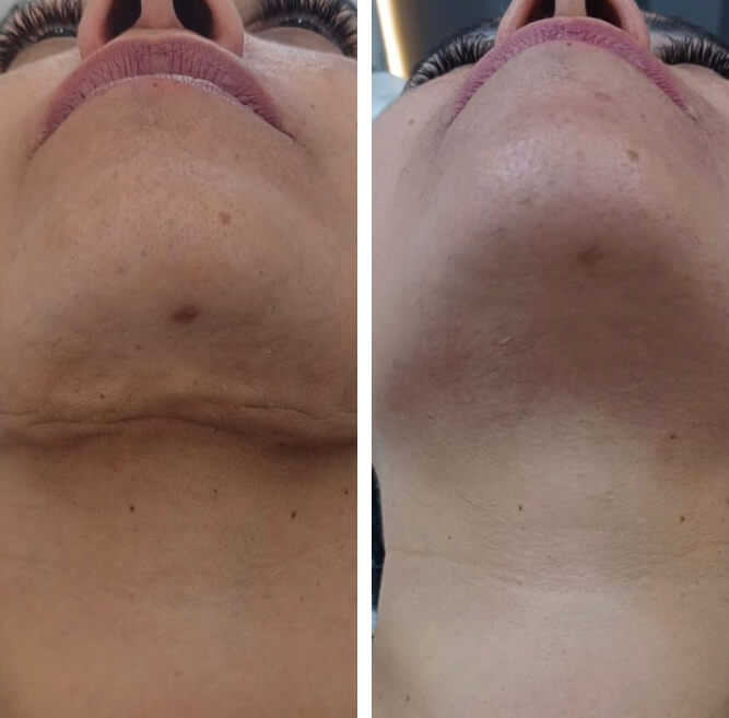 img antes e depois jpg