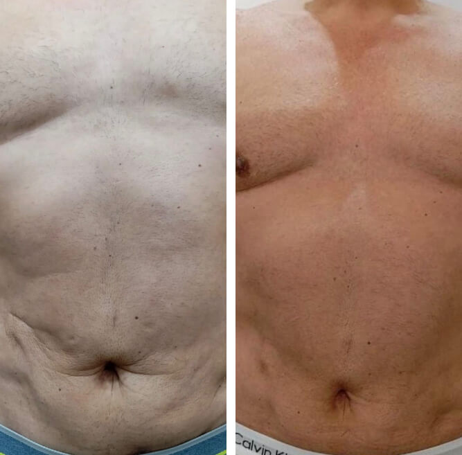 img antes e depois jpg